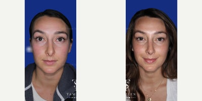Woman treated with Revision Rhinoplasty - Woman treated with Revision Rhinoplasty