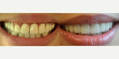 25-34 year old woman treated with Dental Crown - emax crowns and implant supported zirconium crowns