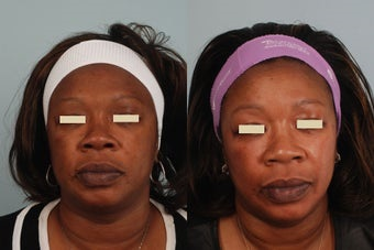 Blue Peel - This patient prepared with the Obagi system then had a blue peel