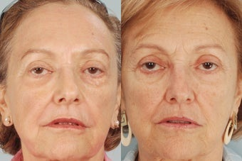 Pearl Laser - Pearl Laser Resurfacing