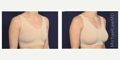 25-34 year old woman treated with Ideal Implant - Breast augmentation. Follow-up photo taken 3 months after the procedure.