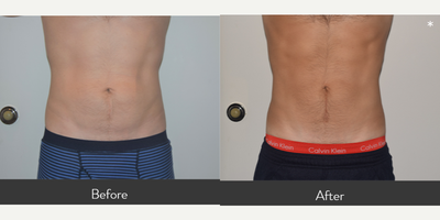 35-44 year old man treated with CoolTone & CoolSculpting - This 36 year old man desired to improve his abdomen and waist and had CoolSculpting treatment to both areas. He is shown before and 2.5 months after 2 rounds of CoolSculpting to his lower abdomen and posterior waist. He also had 4 CoolTone treatments to his abdomen. He has visible improvement and definition to the areas he treated.