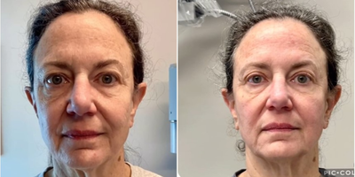 Woman treated with Emface - Our beautiful client after 4 treatments of Emface. Peak result at 3 months!