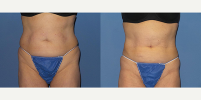 55 year old woman treated with BodyTite - She is a 55 y/o female who had BodyTite liposuction done to her abdomen and flanks