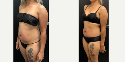 35-44 year old woman treated with JuVaShape - V Shape Ultra by Alma Lasers (JuVaShape) abdominal radiofrequency skin tightening and ultrasound shock fat destruction. The area treated is outlined in red.