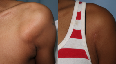 43-year-old woman treated with Lipoma Removal - This patient underwent removal of a large lipoma to the left shoulder using a small, well-positioned scar.