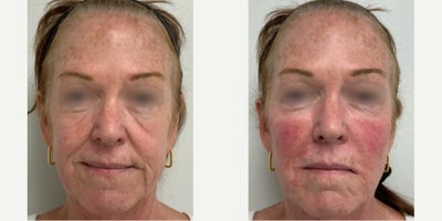 55-64 year old woman treated with 6 cc of Radiesse to the smile lines, marionettes,  and bilateral malar creases. - 62-year-old treated with 6 cc of Radiesse to the smile lines, marionettes,  and bilateral malar creases. Before and after were taken immediately after treatment.