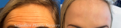 25-34 year old woman treated with Botox - Jeuveau (Newtox) to soften our patients forehead wrinkles.