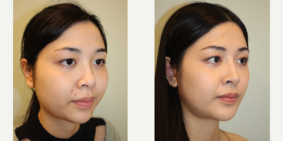 25-34 year old woman treated with Asian Rhinoplasty, Rhinoplasty, Genioplasty, Cheekbone Reduction, Buccal Fat Removal - Augmentation rhinoplasty with patients own diced cartilage and fascia (DCF Graft)
