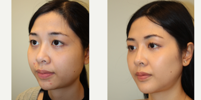 25-34 year old woman treated with Asian Rhinoplasty, Rhinoplasty, Genioplasty, Cheekbone Reduction, Buccal Fat Removal - Augmentation rhinoplasty with patients own diced cartilage and fascia (DCF Graft)