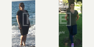 25-34 year old woman treated with Gastric Bypass - Lost 35 kgWe are proud of her