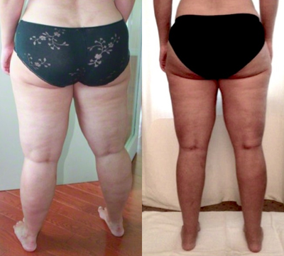 35-44 year old woman treated with Liposculpture - vaser/body jet liposculpture of the full legs and arms for lipedema.