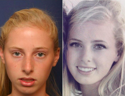 Teen Rhinoplasty - Teen Rhinoplasty