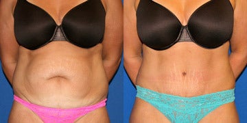 How To Liposuction Love Handles For Best Results - Moein Surgical Arts