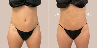 25-34 year old woman treated with AirSculpt - The patient received stomach airsculpt fat removal and done in Raleigh. Results are not 100% complete as this result is only 1 week post-op but already a huge difference.