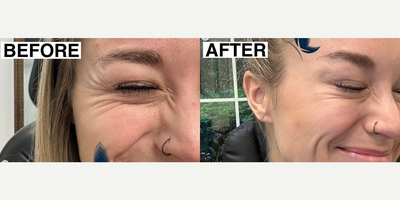 Woman treated with Botox - Woman treated with Botox