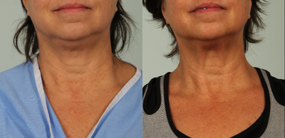 56 year old woman treated with Infini RF - Infini done to full neck. 3 treatments 1 month apart.