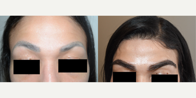 25-34 year old woman treated with Eyebrow Transplant - Result of 800 grafts to eyebrows. 28yo female desired maximally full and prominent eyebrows.