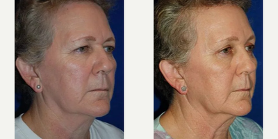 Woman treated with Eyelid Surgery - Woman treated with Eyelid Surgery