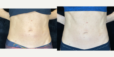 45-54 year old woman treated with Evolve - Evolve Tone by In ModeEvolve Tone is the latest innovation in muscle toning. Evolve Tone is a non-invasive body contouring treatment that uses electric muscle stimulation technology to strengthen, tone, and firm the muscles of the abdomen, hips, buttocks and more. Sometimes you dont get the results you want no matter how many reps you do in the gym or miles you log running. If youre looking to enhance the results you get at the gym and tone your muscles, Evolve Tone might be the answer. Evolve Tone works by emitting electrical muscle stimulation (EMS) to stimulate involuntary muscle contractions. These electrical stimulations create thousands of muscle contractions in a 30-minute session. Try doing that with your typical crunches at the gym! Up to four applicators target specific muscle groups at once to increase muscle strength and refine the look of muscles. This patient only needed two to target her abs. Evolve Tone can add definition to targeted muscle group, enhancing your natural physique. It is a non-invasive treatment that requires no downtime.