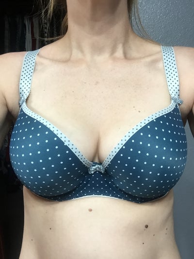 36 Yrs old, 30G - 30D - Review - RealSelf