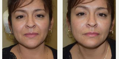 35-44 year old woman treated with Juvederm to the nasolabial folds - This patient did not like the appearance of her nasolabial folds.  They are moderately deep.  She had her nasolabial folds filled once before, 2 years ago, by another surgeon.  She was satissfied with her previous treatment as well as the treatment that I performed as demonstrated in the accompanying photos.  After a thourough evaluation, we choose to use 1cc of Juvederm ultra plus to correct both folds.  The after photo was taken immediately following the injection,  Therefore, the needle marks are visible but will completely dissipate within a day or two.  Bruising is certainly possible following any facial dermal filler injection.
