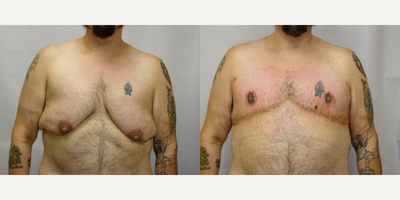 25-34 year old man treated with FTM Chest Masculinization Surgery - Double incision top surgery