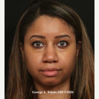 35-44 year old woman treated with African American Rhinoplasty - In May, 2021, a female patient underwent Ethnic Rhinoplasty in Dallas, TX, performed by Dr. George A. Toledo. She reported a positive experience post-surgery, expressing satisfaction with the results. The patient praised the skill and care provided by Dr. Toledo, highlighting the improved aesthetic and functional outcomes achieved through the procedure. The successful rhinoplasty enhanced the patient's confidence and quality of life, reflecting the expertise and professionalism of the surgical team.