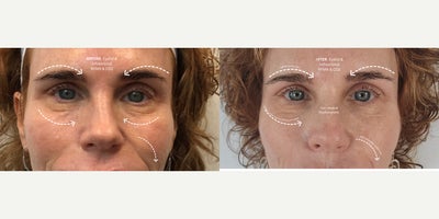 65-74 year old woman treated with CO2 Laser, Secret RF, Microneedling - Treatment: RF Microneedling + CO Laser ResurfacingThese before-and-after photos highlight the remarkable improvement that can be achieved with a customized combination of RF Microneedling and CO laser resurfacing. Notice the smoother skin texture, softening of the lines above and below the eyes, improvement in smile lines, refinement of the chin, reduced cheek creasing, and a more defined jawline. By stimulating collagen production while resurfacing the skin, this treatment improves overall skin quality, firmness, and texture for a naturally refreshed appearance. My patient is absolutely thrilled with her results, and the improvement will continue as collagen remodels over the coming months.