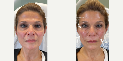 Woman treated with Facial - Woman treated with Facial