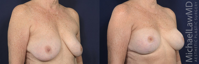 65-74 year old woman treated with Mentor Breast Implants - Augmentation mastopexy. Follow-up photo taken 1 year after the procedure.