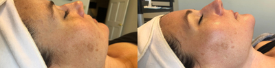 25-34 year old woman treated with Dermaplaning - This patient received a dermaplaning and chemical peel combo.