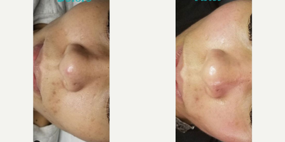Woman treated with Dermaplaning - Woman treated with Dermaplaning