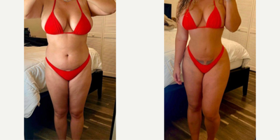 Woman treated with Brazilian Butt Lift - Woman treated with Liposuction and Brazilian Butt Lift through fat transfer to buttocks