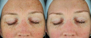 Woman treated with Glacial Rx - Woman treated with Glacial Rx