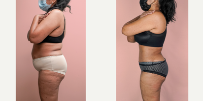 55-64 year old woman treated with Liposuction - This lovely patient requested help in improving her shape and removing the sagging skin from her abdomen. She was able to turn back the clock and look 30 years younger with a combination of tummy tuck and 360 liposuction.