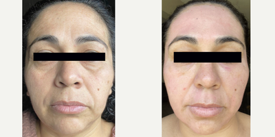 Laser Resurfacing and Restylane injections for tired under eyes. - Patient was treated using the Sciton Mcirolaser peel (only 1!) and 1 syringe of Restylane under the eyes.  Fine lines and wrinkles as well as tired eyes and sun damage were all addressed with these two procedures over a 2 week time period.