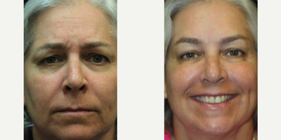 50 year old woman treated with Botox for Migraines - 50 year old woman seeking to address early signs of aging consulted with Dr. Kris Reddy FACS. Dr. Reddy performed Botox about 40 units and dermal fillers (1 syringe of Juvederm Ultra in the nasolabial folds and perioral lines and 1 syringe of Voluma for the lower face and chin area). Patient wanted to have Botox performed for cosmetic reasons and to treat migraine headaches.