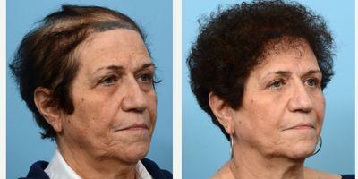 65-74 year old woman treated with Low-Level Laser Therapy - This 71-year-old patient was experiencing a lot of hair loss in addition to thinning on the sides and crown. To fill in these areas and add density overall, Dr. Wise performed an FUT hair transplant using 2,030 grafts, during which she also underwent one session of PRP.