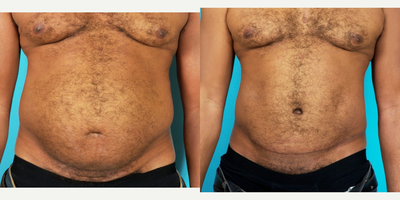 45-54 year old man treated with Painless/Drainless Tummy Tuck 8 Months Post-Op - Dr. Feng performed tumescent liposuction of the hips and back to improve the contour of the trunk. She then performed intercostal blocks prior to starting the abdominoplasty and repairing the large tear in the diastasis recti. She anchored the subcutaneous tissue down to the muscle layer using progressive tension sutures to achieve a better definition of the abdomen and to avoid the use of drains. The after photos are 8 months post-op.