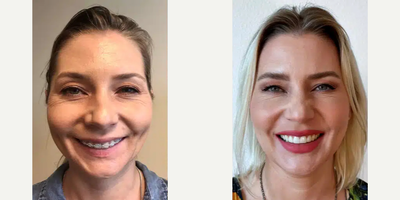 35-44 year old woman treated with Jaw Surgery - Female patient presenting with a common case of orthodontic camouflage treatment and its subsequent failure. A maxillomandibular advancement (MMA) procedure, otherwise known as double jaw surgery, was performed. The patient underwent a LeFort 1 osteotomy on her maxilla and a segmental bilateral sagittal split osteotomy (BSSO) on her mandible along with a counter-clockwise (CCW) rotation to bring the occlusal plane into it's optimal position and optimize both form and function. The lower jaw (mandible) was ultimately brought forward by 12.94mm at the pogonion (the forward-most point on the chin), and the upper jaw (maxilla) was brought forward by 5mm. A counter-clockwise rotation of approximately 8 degrees was also performed to lengthen the lower third of the face to balance the bimaxillary movements, further improve the airway, stabilize the occlusion (the bite), and achieve complete facial harmony. 3D-printed custom orthognathic hardware by Stryker was used for the procedure.