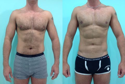Abdominal Etching - Patient used to be an underwear model in his youth, glad to say hes able to go back now in his 40s