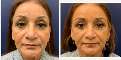 55-64 year old woman treated with Eyelid Surgery - upper eyelids