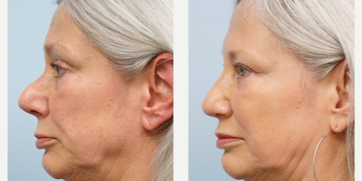 55-64 year old woman treated with Revision Rhinoplasty - She had rhinoplasty 30 years ago but d/t scarring and skin thickness, her over projected thick skin nose is refined and reduced to a more natural appearance. Thick skin noses are difficult to make thin.