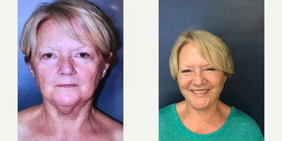 65-74 year old woman treated with Facelift (The Angle Lift) - 65 year old woman treated with my version of a facelift facelift, The Angle Lift.
