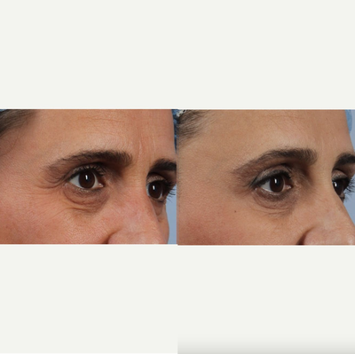 45-54 year old woman treated with Botox - 45-54 year old woman treated with Botox
