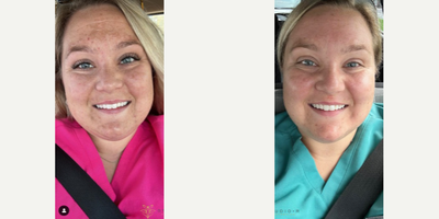 Moxi Before & After Pictures - RealSelf