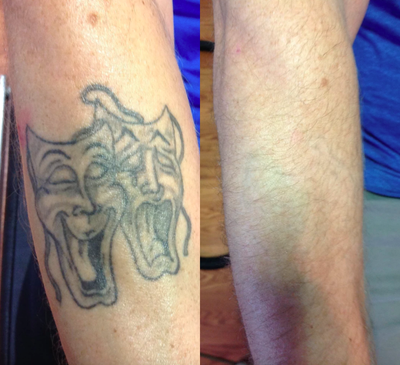 25-34 year old man treated with PicoSure - Picosure tattoo removal after 5 treatments.