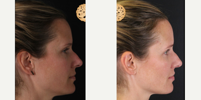 35-44 year old woman treated with Dermalinfusion - Dermal Infusion - Before & After