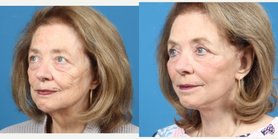 75 and up year old woman treated with Eyelid Surgery, Facelift, Facial Fat Transfer, Neck Lift - 75 and up year old woman treated with Eyelid Surgery, Facelift, Facial Fat Transfer, Neck Lift